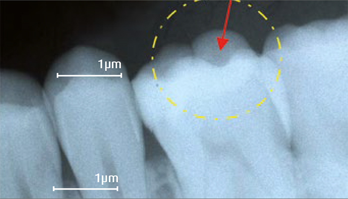 estelite-posterior-quick-röntgenopacitás
