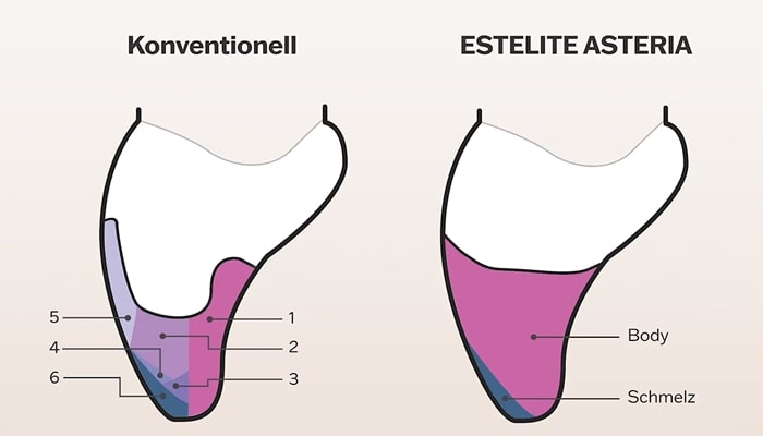Vereinfachte Schichttechnik mit ESTELITE ASTERIA