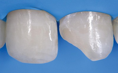 Abb. 2: Isolierung mit Kofferdam