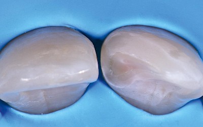 Fig. 3: Optimal preparation of the bevel