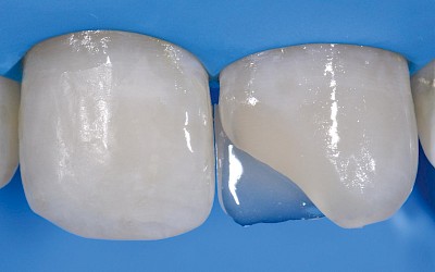 Fig. 4: Application of the blocker as palatal wall