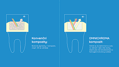 Grafické srovnání technologie konvenčních kompozitů vs. OMNICHROMA
