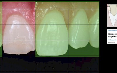 Abb. 3: Die Ästhetikanalyse zeigt eine Asymmetrie des gingivalen Zenits